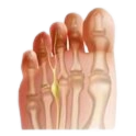 Morton’s Neuroma-belridge