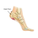 Plantar Heel Pain-belridge