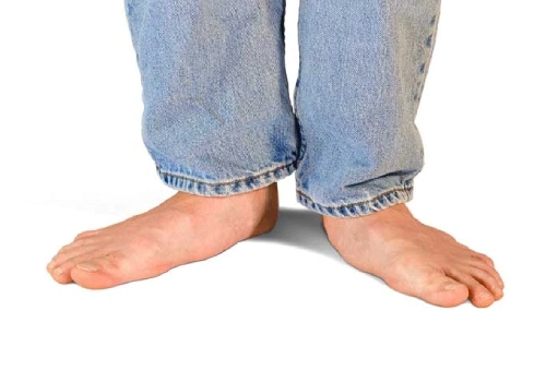 Flat Feet Causes - Belridge Podiatry