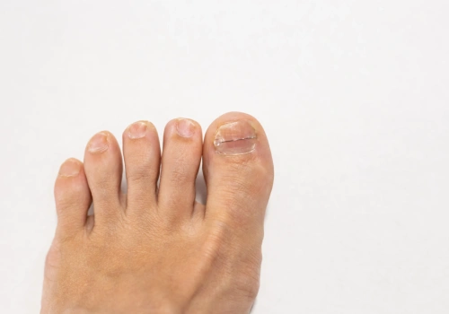 Ingrown Toenails Causes - Belridge Podiatry