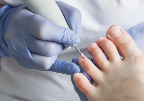 Ingrown Toenails Treatment - Belridge Podiatry