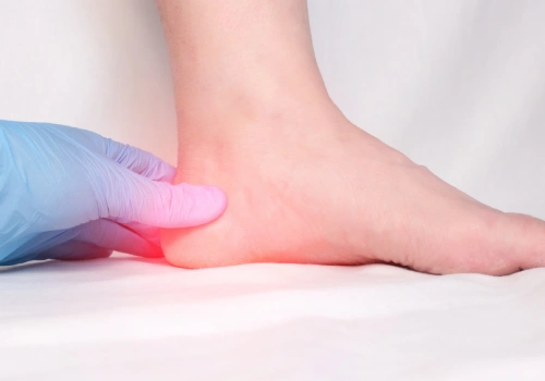 Plantar Heel Pain​ Signs and Symptoms - Belridge Podiatry